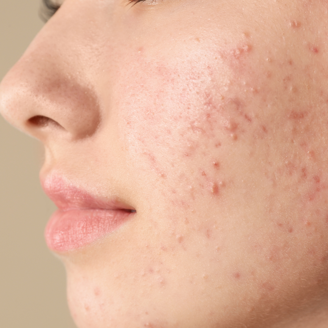 Rimedio naturale contro l'acne