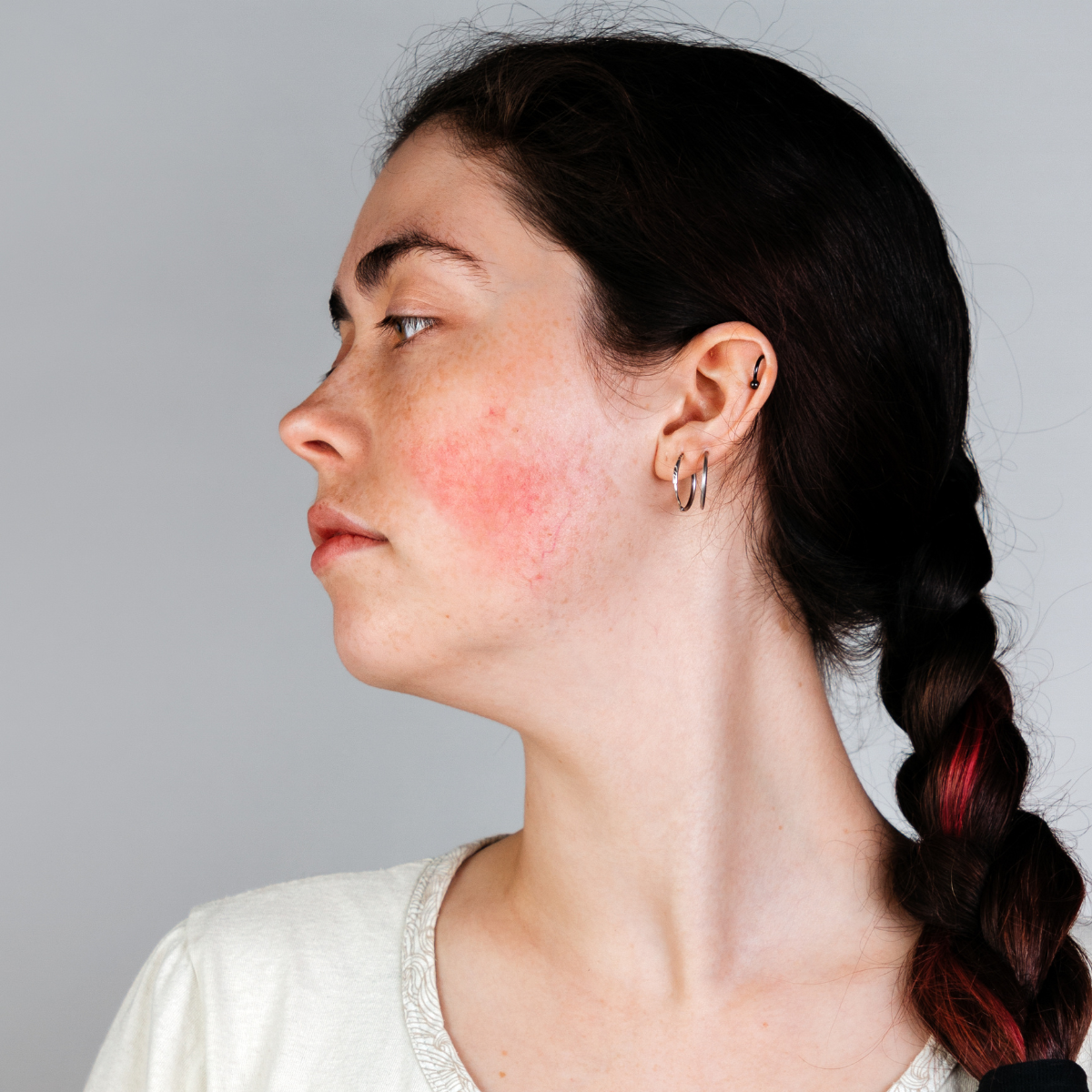 Rosacea